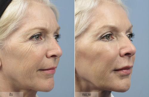 Сколько держится мезоботокс. Что такое мезоботокс и с чем его едят