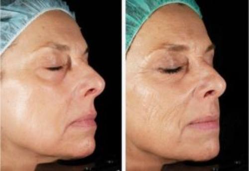 Лазерные процедуры в косметологии. Показания к лазерной терапии