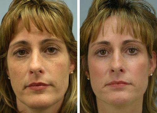 Химический пилинг с трихлоруксусной кислотой. ТСА пилинг и все, что о нем нужно знать