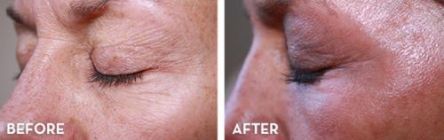 Лазер для лица в косметологии паломар. Лазер Паломар (Рalomar) – комфортное лазерное омоложение