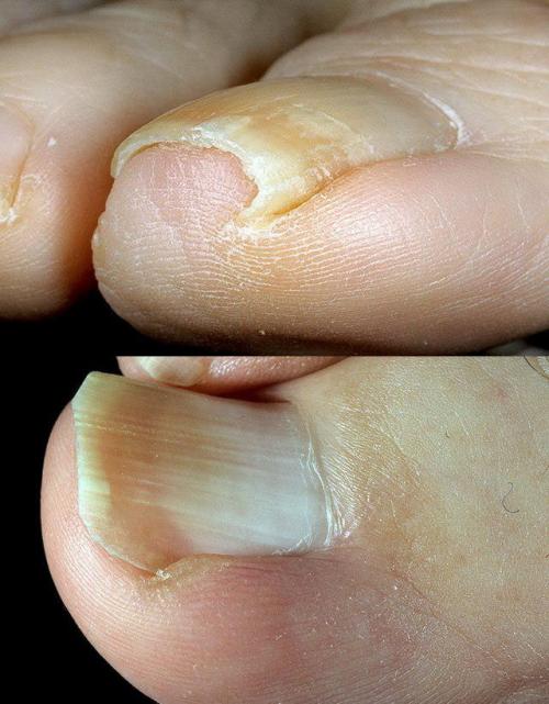 Пластины для коррекции вросшего ногтя в домашних условиях. Вросший ноготь: как лечить в домашних условиях