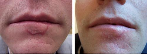 Лазер для лица в косметологии паломар. Лазер Паломар (Рalomar) – комфортное лазерное омоложение