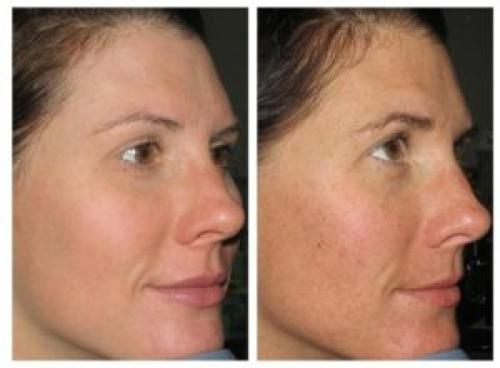 Лазерные процедуры в косметологии. Показания к лазерной терапии