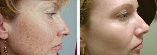 Лазер для лица в косметологии паломар. Лазер Паломар (Рalomar) – комфортное лазерное омоложение