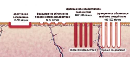 Лазерное омоложение уход после. Преимущества лазерного омоложения лица