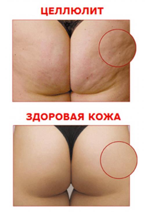 Почему появляется целлюлит у подростков. Почему возникает целлюлит в 14 лет