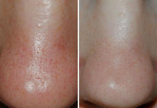 Очень расширены поры на всем лице причины и лечение. Как избавиться от расширенных пор на лице