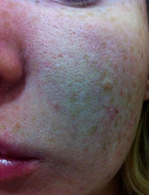 Очень расширены поры на всем лице причины и лечение. Как избавиться от расширенных пор на лице