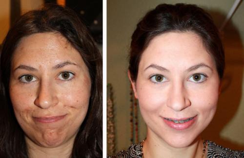 Химический пилинг с трихлоруксусной кислотой. ТСА пилинг и все, что о нем нужно знать