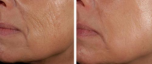 Лазер для лица в косметологии Паломар. Лазер Паломар (Рalomar) – комфортное лазерное омоложение