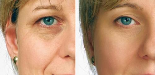 Аппаратная Косметология лазерное омоложение. Преимущества лазерного омоложения лица