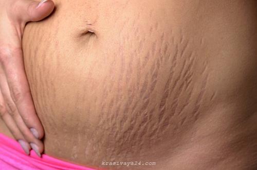 Растяжки на животе после родов лазерное удаление. Удаление растяжек лазером