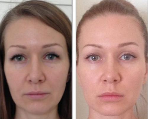 Гимнастика для лица упражнения для лица Фейслифтинг. Упражнения и результаты фейслифтинга для лица