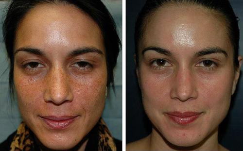 Алмазная дермабразия – поговорим о микрокристаллах