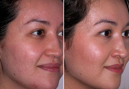 Алмазная дермабразия – поговорим о микрокристаллах