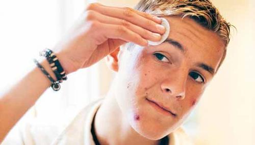 Уход за кожей лица угри. Основные правила ухода за лицом при прыщах и угрях