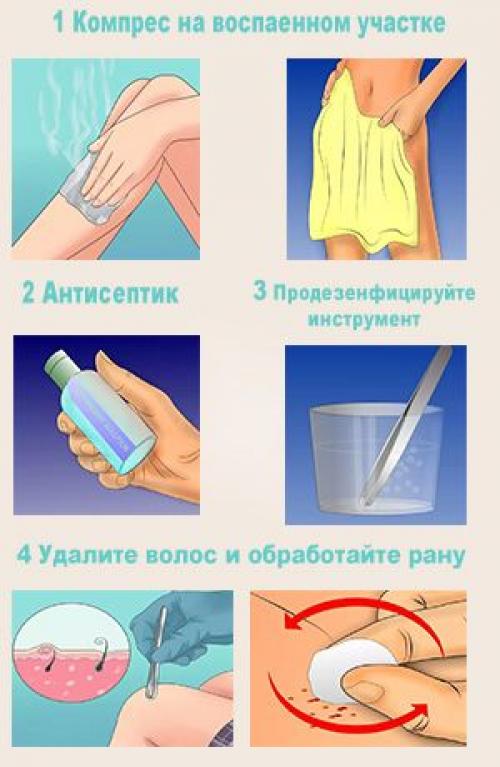 Как бороться с вросшими волосами после шугаринга в зоне бикини. Что делать, если появились вросшие волосы после шугаринга?