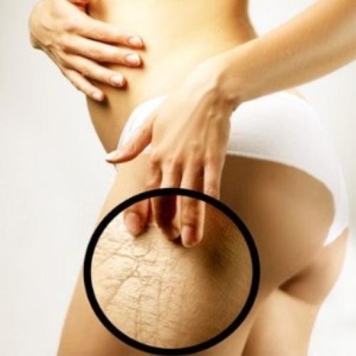 Пластическая хирургия удаление растяжек. Можно ли при помощи пластической хирургии удалить растяжки?