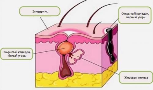 Большие поры на лице, как избавиться у мужчин. Как бороться с расширенными порами на лице
