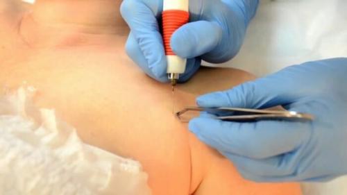 Как бороться с вросшими волосами после шугаринга. Салонные методы удаления