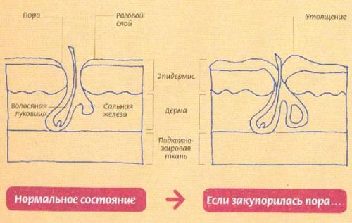 Как избавиться от забитых пор на лице. Зачем нужно чистить поры
