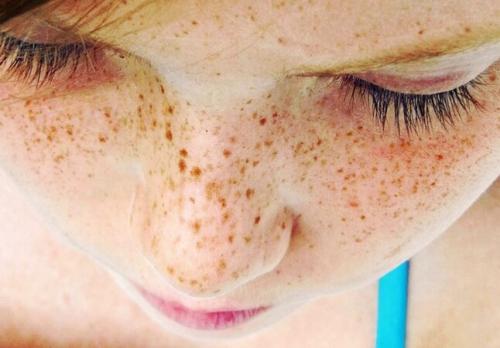 Причина нарушений в пигментации кожи. Что важно знать о нарушении пигментации кожи