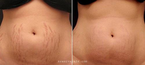 Растяжки на животе после родов лазерное удаление. Удаление растяжек лазером