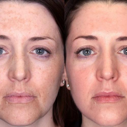 Крем гиалуроновый увлажняющий для лица шеи и области декольте Либридерм. Отзывы на гиалуроновый увлажняющий крем Либредерм для лица, шеи и декольте