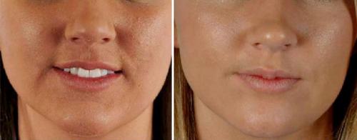 Алмазная дермабразия – поговорим о микрокристаллах