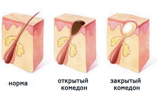 Уход за кожей лица при угревой болезни. Как образуются угри?