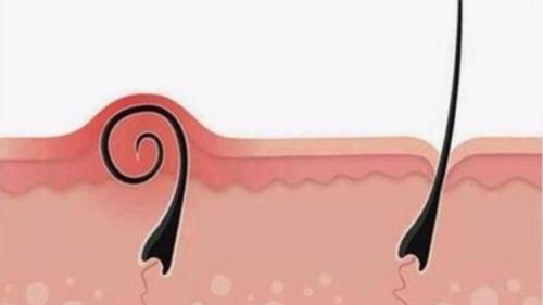 Как бороться с вросшими волосами в зоне бикини. Причина возникновения проблемы