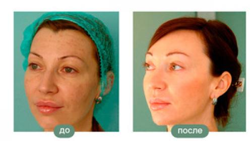 Фейслифтинг для лица три упражнения. Фейслифтинг для лица: как правильно выполнять упражнения