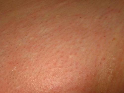 Как избавиться от зуда после лазерной эпиляции. Раздражение после лазерной эпиляции