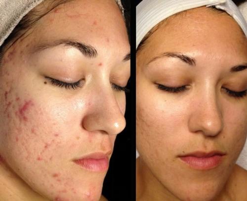 Алоэ маски для лица. Отзывы женщин о применении масок для лица с алоэ