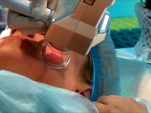 Микродермабразия от атрофических рубцов. Методы лечения атрофических рубцов на лице