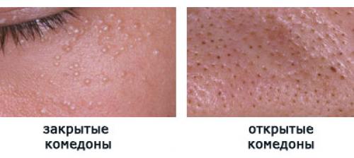 Уход за кожей лица при угревой болезни. Как образуются угри?