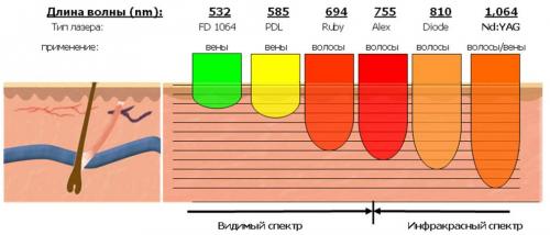 После лазерной эпиляции на лице. Типы лазеров для эпиляции
