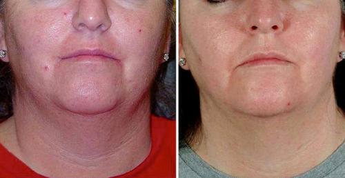 Алмазная дермабразия – поговорим о микрокристаллах