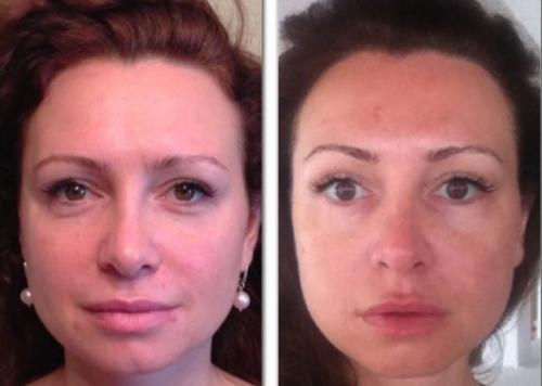 Гимнастика для лица упражнения для лица Фейслифтинг. Упражнения и результаты фейслифтинга для лица