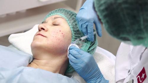 Микродермабразия от атрофических рубцов. Методы лечения атрофических рубцов на лице