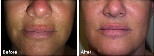 Алмазная дермабразия – поговорим о микрокристаллах