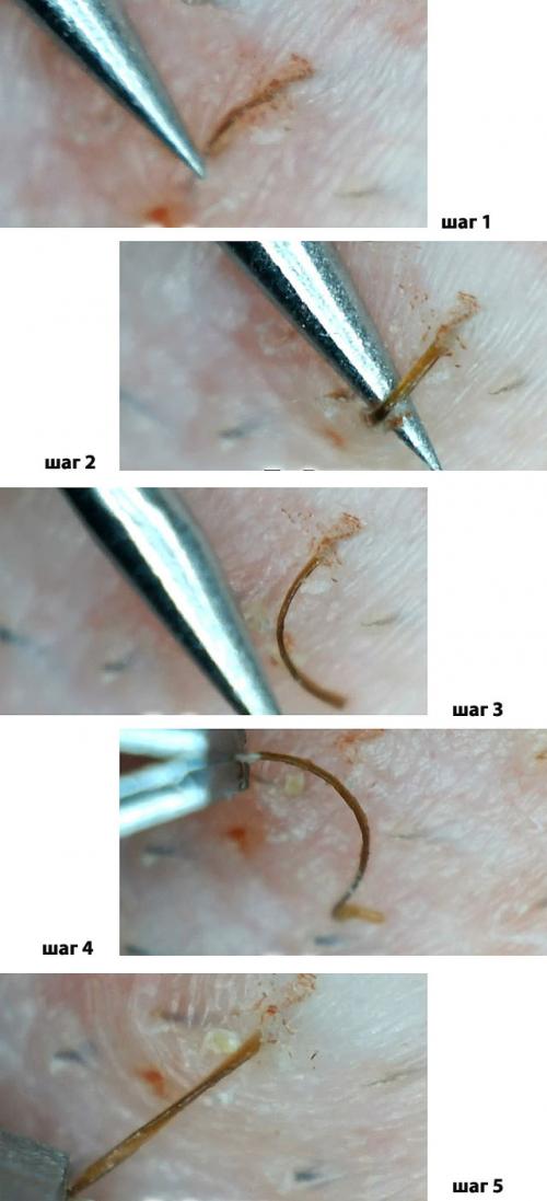 Как убрать вросшие волосы в зоне бикини в домашних условиях. Меры борьбы