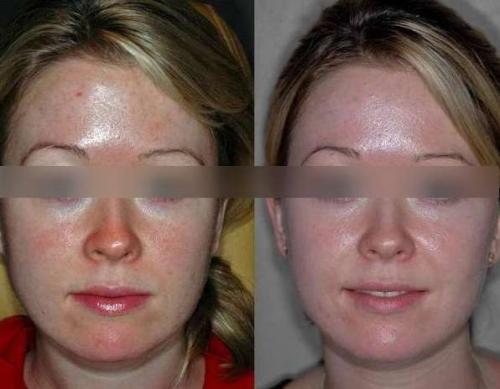 Роз де Мер коралловый пилинг. Отзывы с фотографиями до и после процедур пилинга Rose De Mer