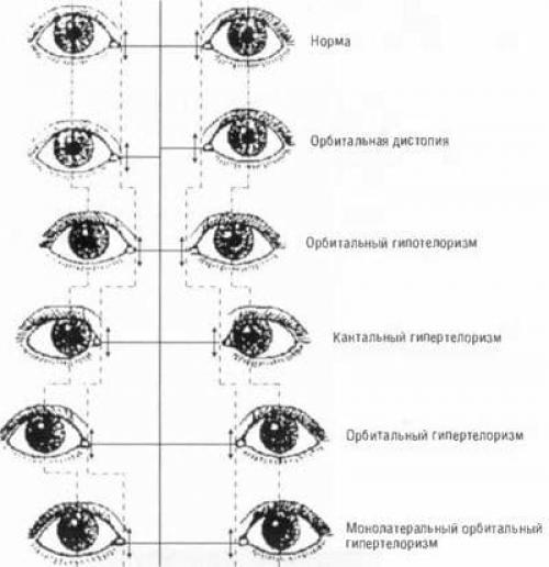 Широко посаженные глаза болезнь. Определение заболевания