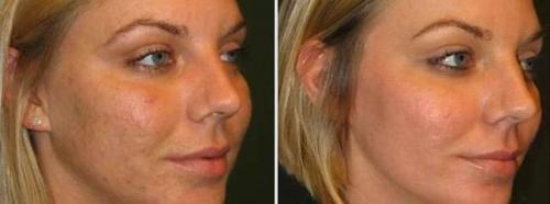 Роз де Мер коралловый пилинг. Отзывы с фотографиями до и после процедур пилинга Rose De Mer