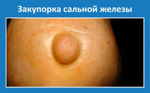 Как очистить сальные железы на голове. Как очистить поры, убрать сальные пробки?