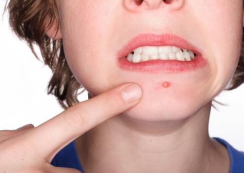 Как очистить сальные железы на голове. Как очистить поры, убрать сальные пробки?