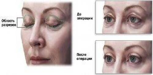 Избавиться от синяков под глазами. Как убрать синяки под глазами домашними методами 04 Избавиться от синяков под глазами. Как убрать синяки под глазами домашними методами 04