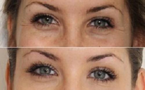 Избавиться от синяков под глазами. Как убрать синяки под глазами домашними методами 02 Избавиться от синяков под глазами. Как убрать синяки под глазами домашними методами 02