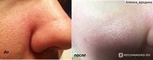 Как почистить кожу головы от сальных пробок в домашних. Масло касторовое